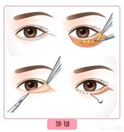 眼袋有皱纹该怎么消除