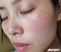 脸上有斑点，适合用什么遮住