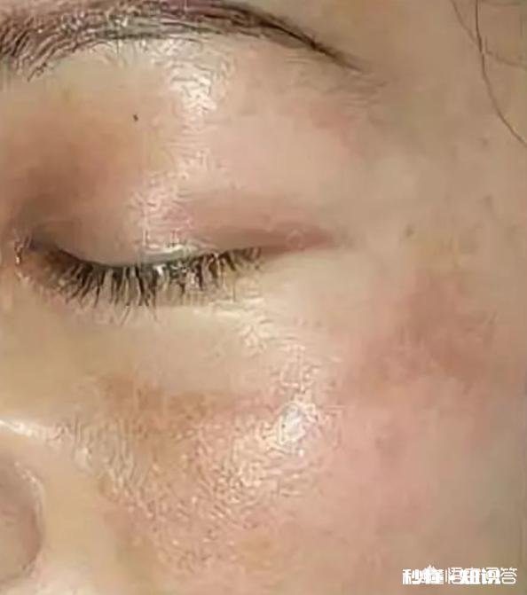 脸上有斑点，适合用什么遮住