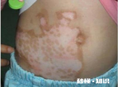 白癜风在生活中治疗中有哪些注意事项