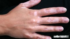 白癜风在生活中治疗中有哪些注意事项