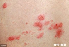 带状疱疹能传染儿童吗