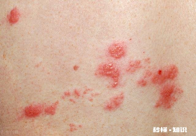 带状疱疹能传染儿童吗