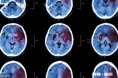 哪些原因会导致中风脑溢血