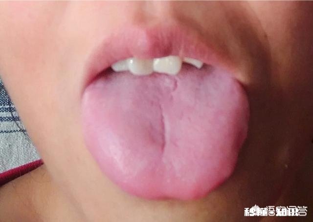 严重口臭吃点什么药能治疗