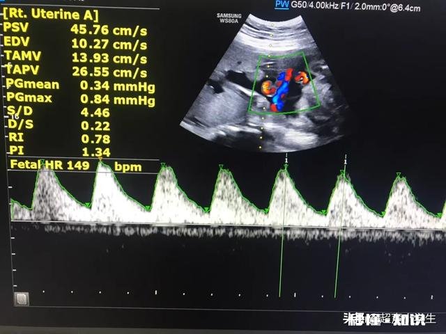 怀孕生男孩，胎心率是每分钟多少下怀孕时应注意什么