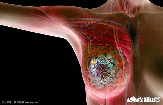 乳腺癌患者颈肩综合征可以做按摩吗