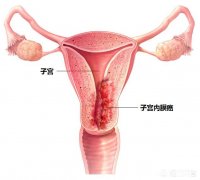 子宫癌是怎样得的