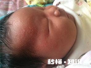 宝宝怎么预防湿疹