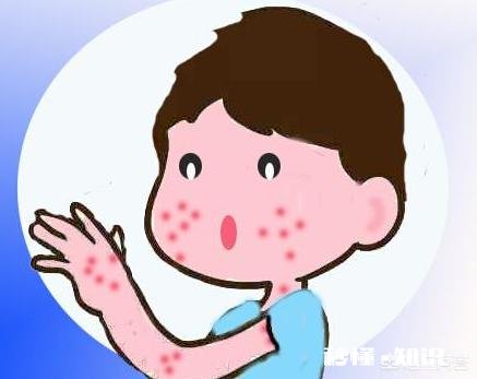 宝宝怎么预防湿疹