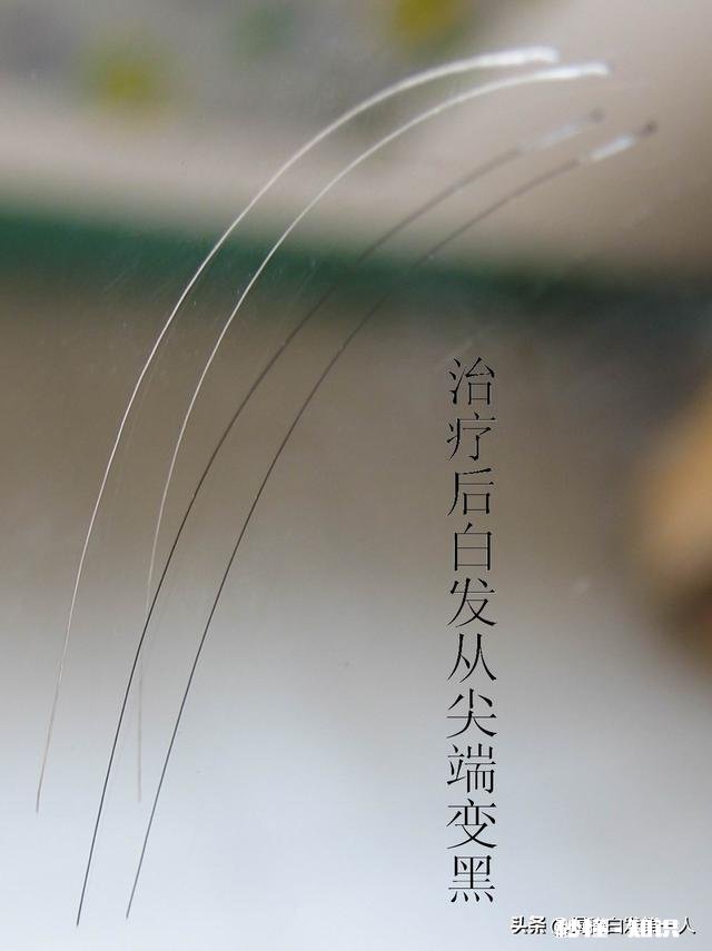 现在越来越多年轻人白发严重是什么原因造成的