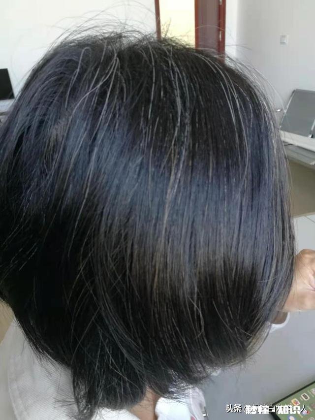 现在越来越多年轻人白发严重是什么原因造成的