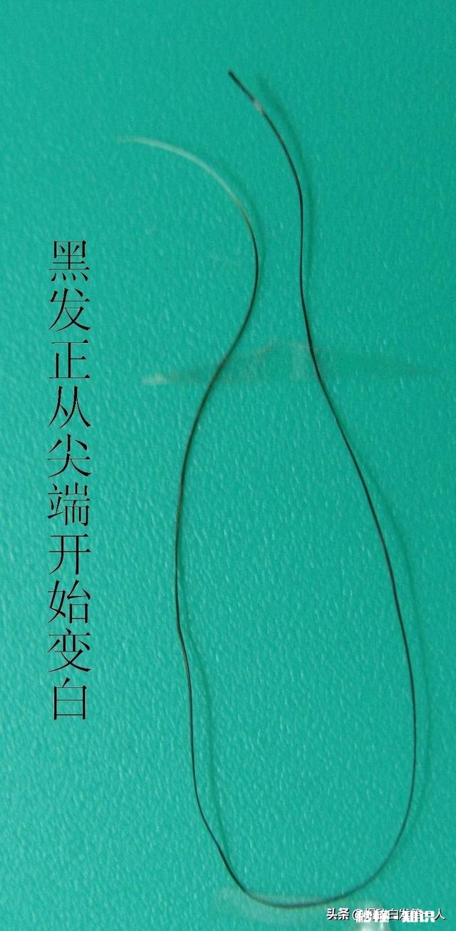 现在越来越多年轻人白发严重是什么原因造成的