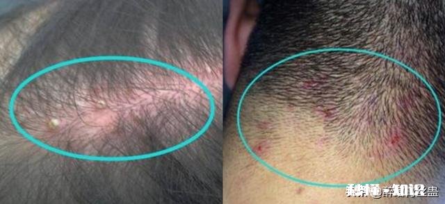 洗了头还是油油的，还“长痘”，这可要怎么办啊