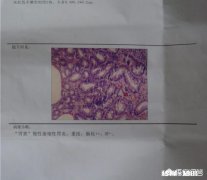 患了幽门螺杆菌，这种病能自愈吗