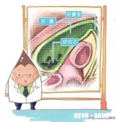 胆结石会有不均质高回声吗