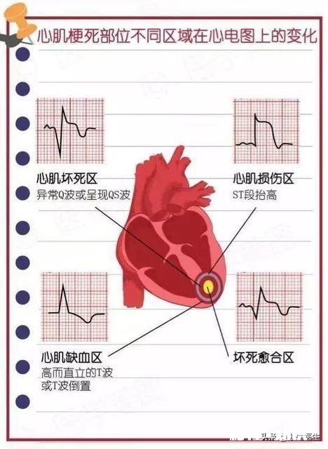 急性心肌梗死怎么判断