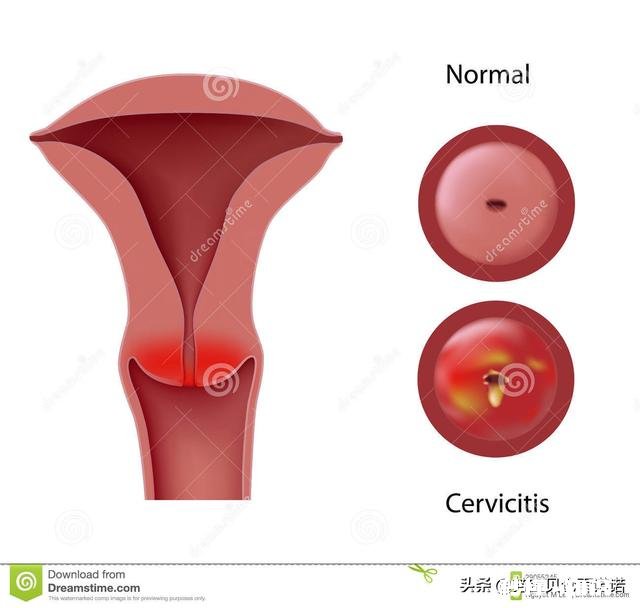 宫颈炎会影响怀孕吗