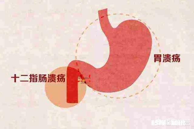 十二指肠溃疡能成癌吗