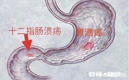 十二指肠溃疡能成癌吗