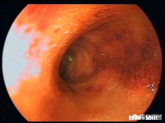 十二指肠溃疡能成癌吗