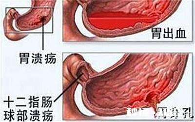十二指肠溃疡能成癌吗