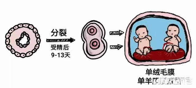 连体婴儿是如何形成的这个遗传吗